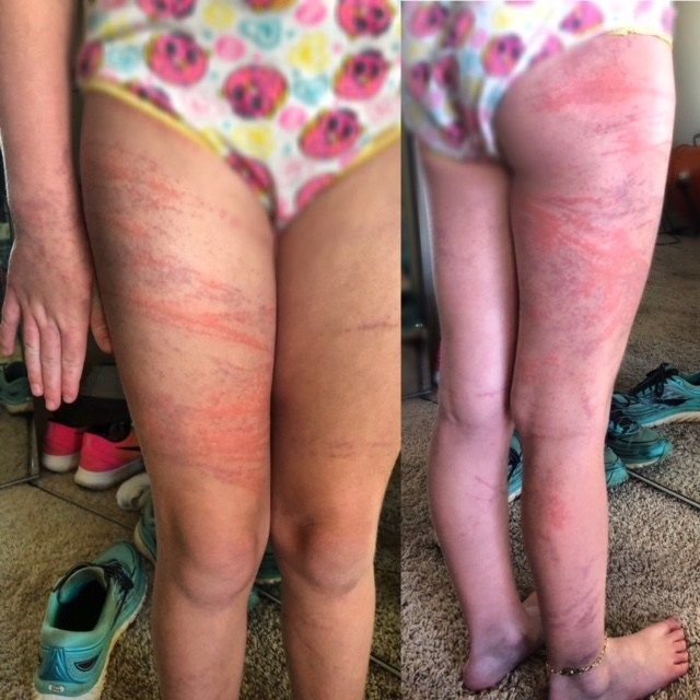 Family warns other Gulf Shores swimmers to beware of stinging marine life
